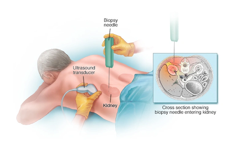 Renal interventions 02n
